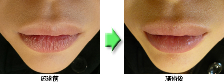 リップエステの施術例